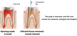 Root Canal Diagram