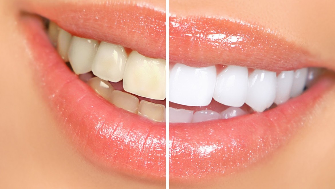 How Much Does Teeth Whitening Cost Without Insurance  