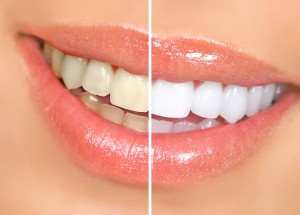 tooth whitening cost