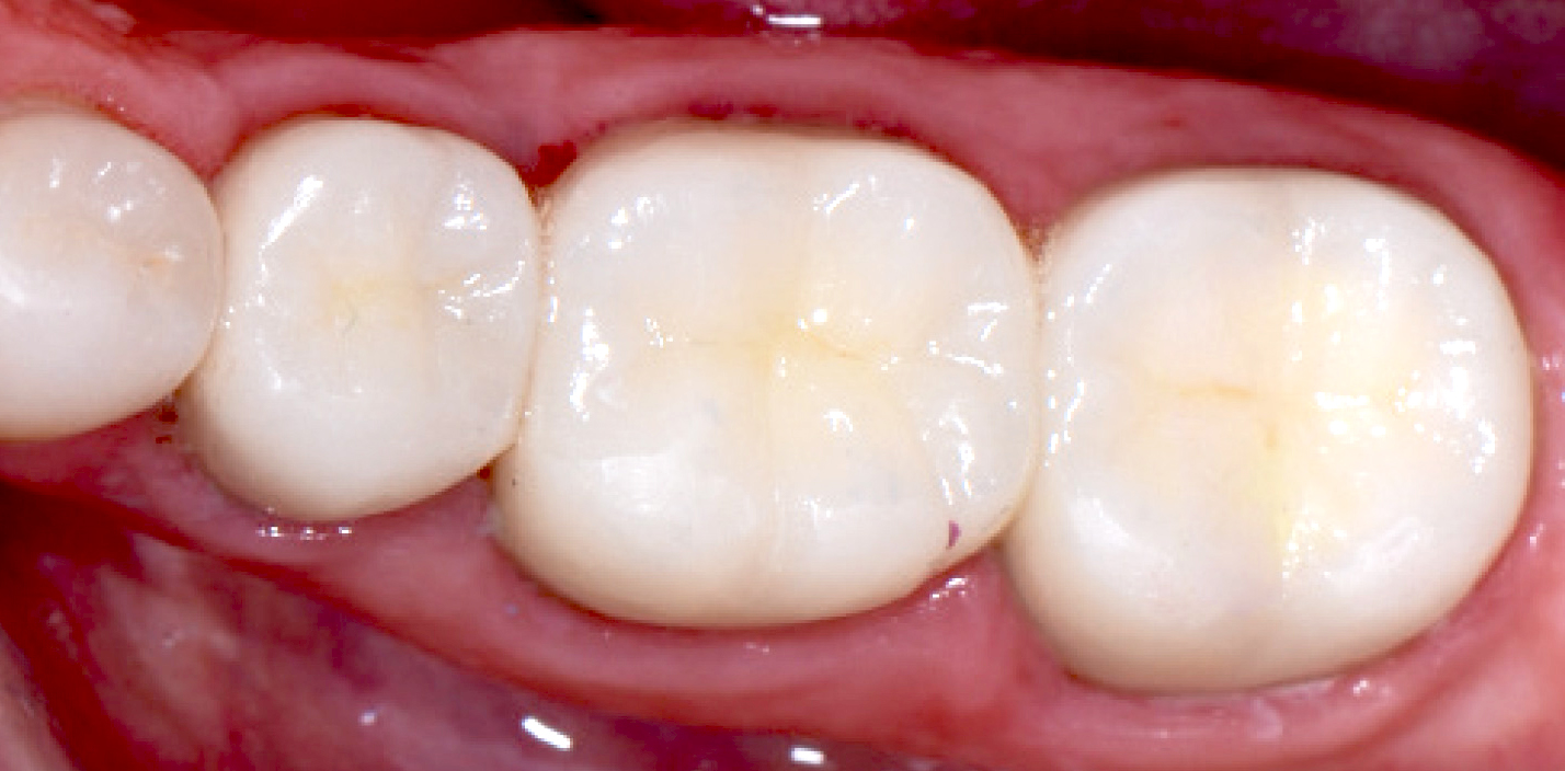 What you should know about Composite Fillings