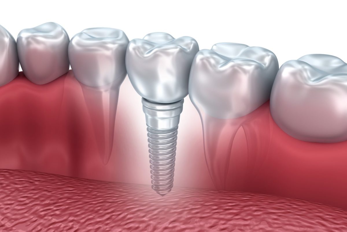 Everything you need to know about Dental Implants | Golden Smiles Dental