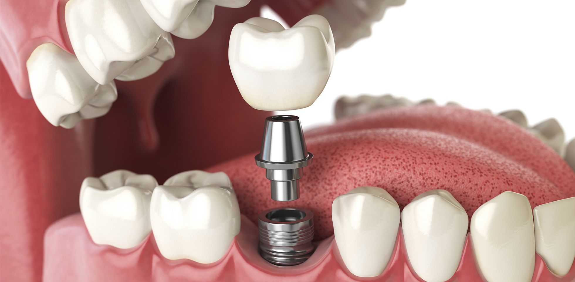 Benefits of All on 4 Implants vs. Dentures