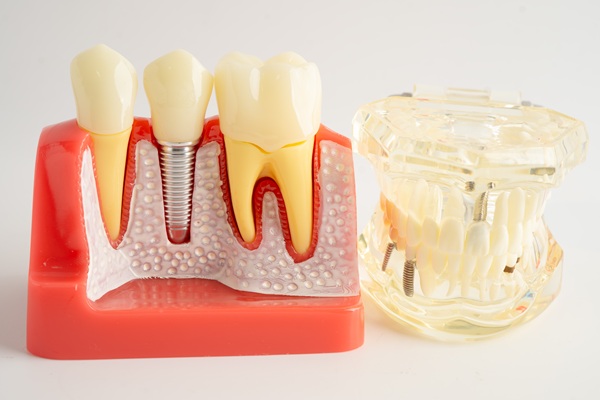 Dentures Vs  Dental Implants: Which Is The Right Choice For You?