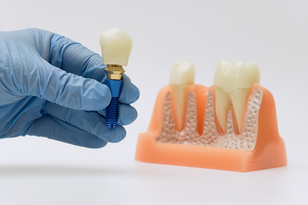 Signs You Might Need Dental Implants Sooner Than You Think