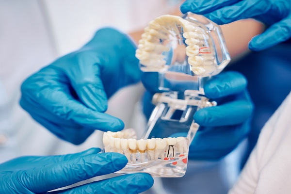 Why Implant Supported Dentures Are A Life Changing Solution For Missing Teeth
